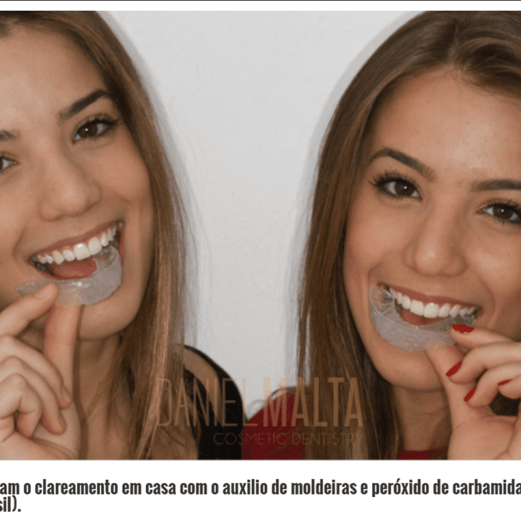 Tudo sobre Clareamento Dental: dicas do especialista - Trindade Odontologia