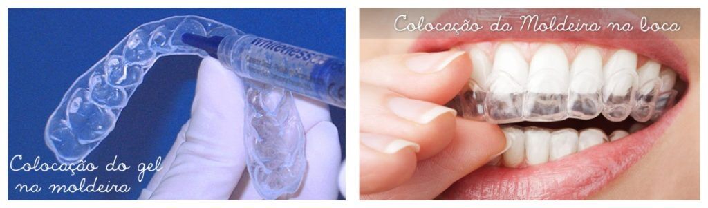 Clareamento Dental Caseiro ou a Laser: qual o melhor?