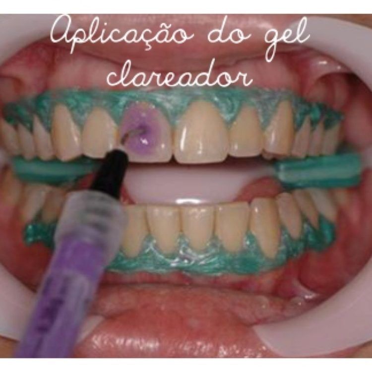 Clareamento Dental Caseiro ou a Laser: qual o melhor?