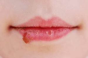 Herpes Labial